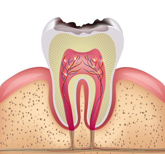 Todo Lo Que Debes Saber Sobre Los Empastes Cl Nica Dental En Ciudad