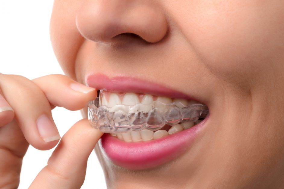 Cómo limpiar paso a paso mi Invisalign para que quede perfecto