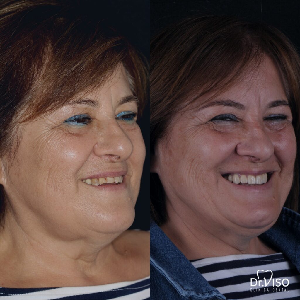 Casos de antes y después carillas dentales