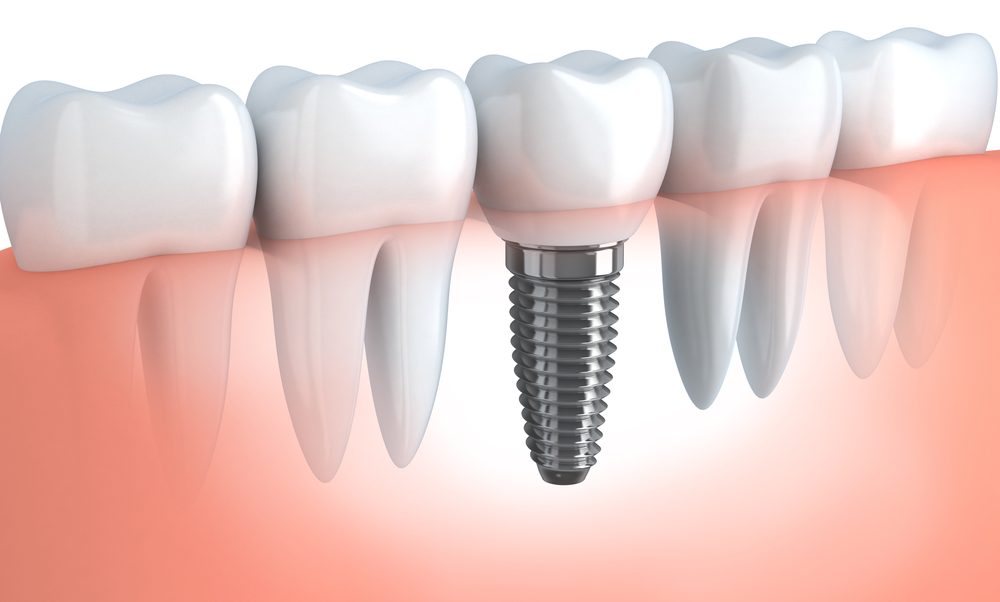 Render implante dental