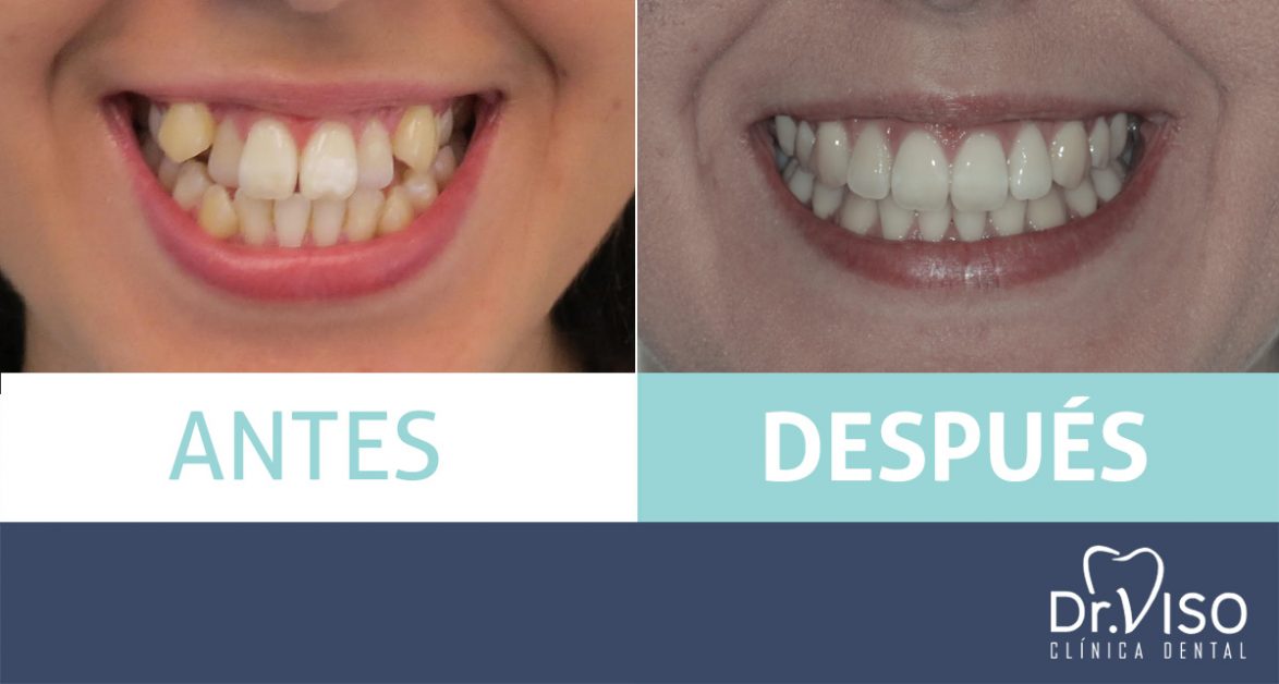 ¿Por qué los brackets metálicos son la opción más utilizada? Clínica