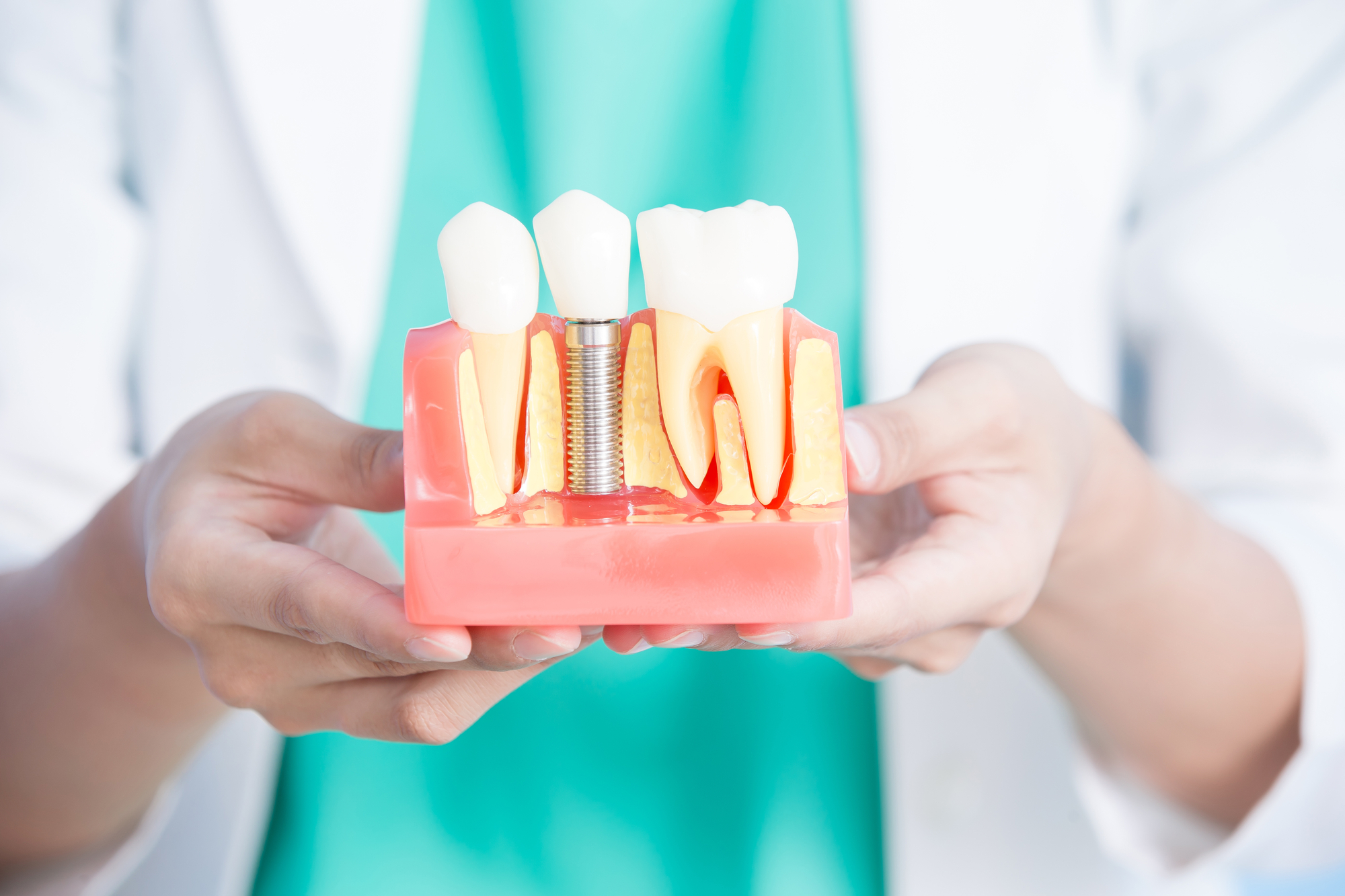 ¿Cuánto dura un implante dental? - Clínica Dental en Ciudad Real - Dr Viso