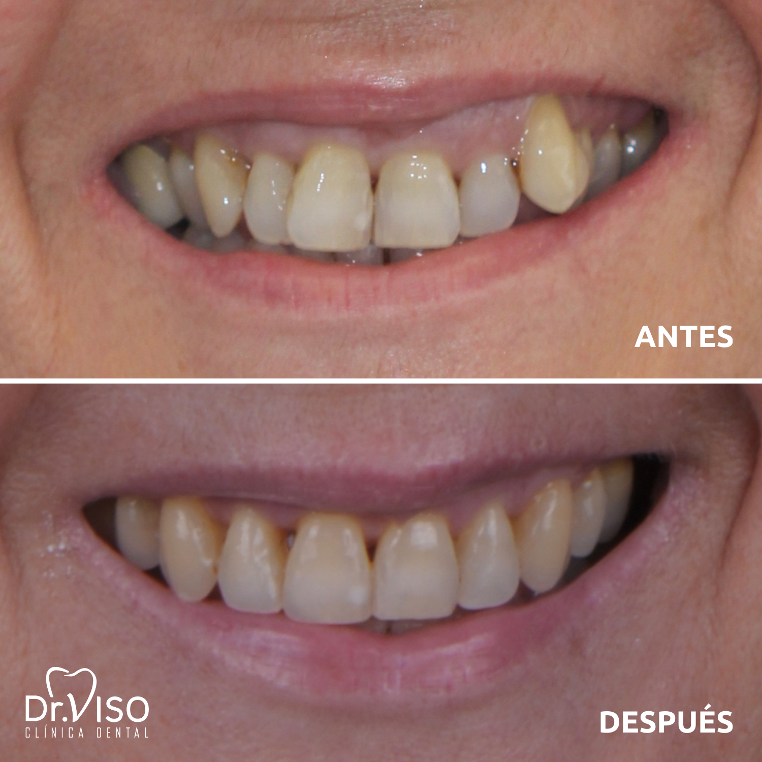 antes y después ortodoncia